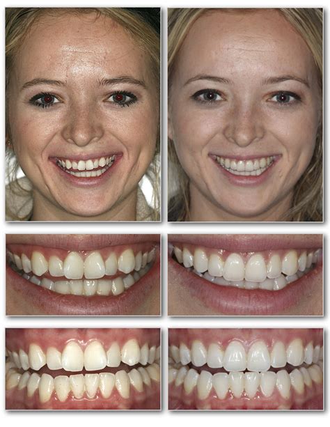 Invisalign Before And After — Invisalign Studio