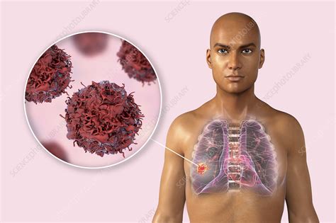 Lung Cancer Illustration Stock Image F034 4505 Science Photo Library