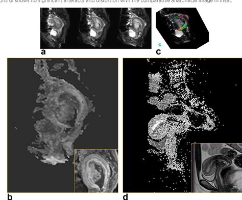 Figure 3 From Read Out Segmented Echo Planar Diffusion Imaging Of The