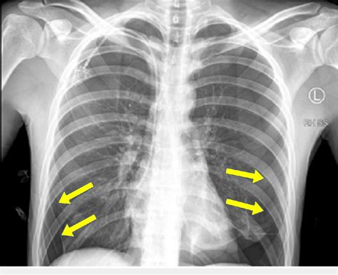 Chest X Ray Report