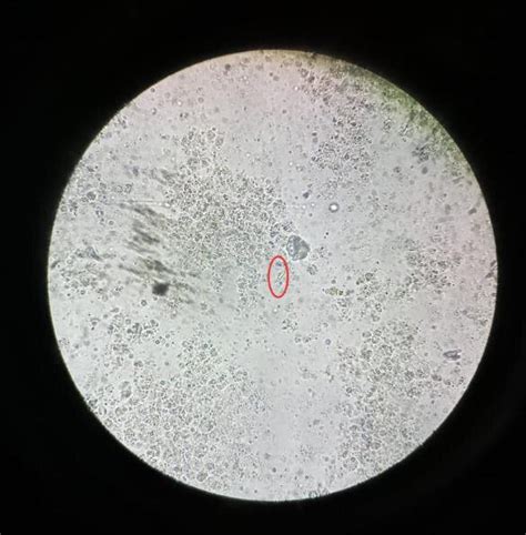 Gram Staining Of The Pus Done By Hucker S Modification Showing Hooklets