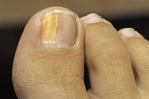 Problemas En Las Uñas De Los Pies Moda y Estilo