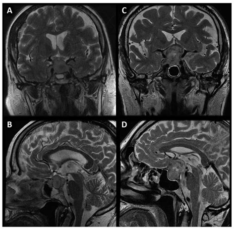 Jcm Free Full Text Evaluation Of The Value Of Perfusion Weighted