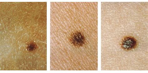 How To Check A Mole On Your Skin For Skin Cancer Business Insider