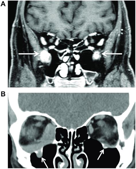 (A) Apparent bilateral infraorbital canal and nerve infiltration ...