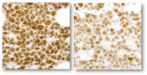 Bone Marrow Biopsy The Blasts Are Positive For Pax A And Tdt B