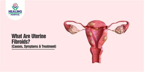 What Are Uterine Fibroids Causes Symptoms And Treatment Healing Hospital