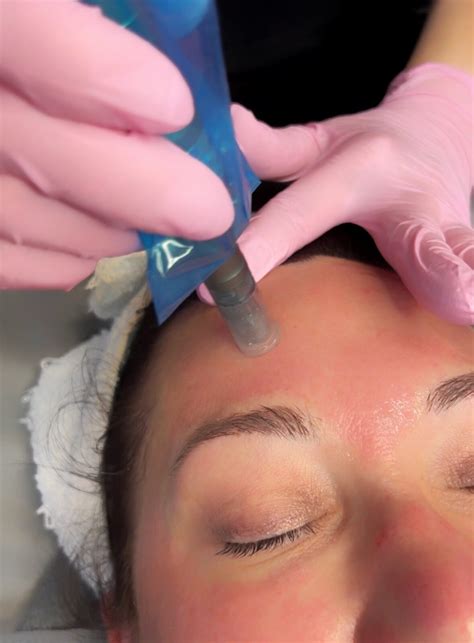 What To Expect Before And After Microneedling Elysian