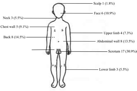 Distribution of subcutaneous nodules in body | Download Scientific Diagram