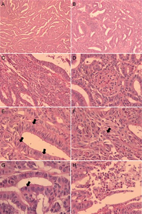 Figure From Cribriform Morular Variant Of Papillary Thyroid Carcinoma