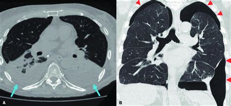 CT scans showing acute pleural complications after LT. A: Moderate ...