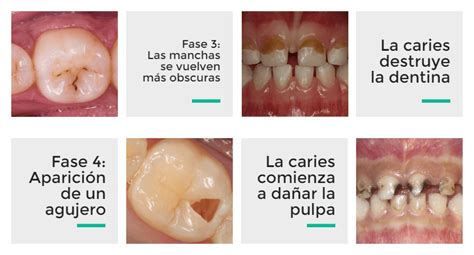 Cómo identificar si tus hijos tienen caries Proceso de la caries