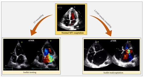 Functional Mitral And Tricuspid Regurgitation Across The Whole Spectrum