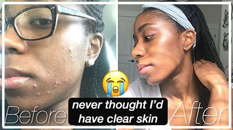 How I Cleared My Adult Acne Finally Hormonal Cystic Acne Youtube