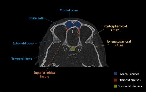 Cranial Bone Anatomy Ct Axial