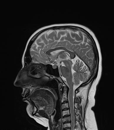 Pituitary Metastasis Radiology Case Radiopaedia Org