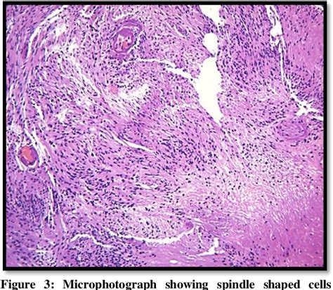 Figure From Large Retroperitoneal Schwannoma A Rare Case Report