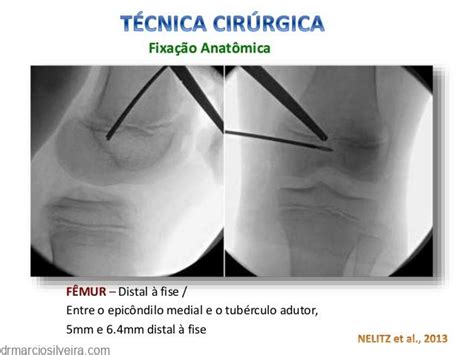 Luxa O Da Patela Em Crian As Dr M Rcio Silveira