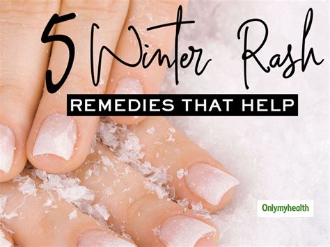 View 21 Dry Skin Rash Winter Eczema On Hands - suddenlyinfopics