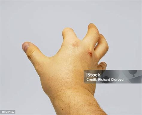 Amputated Finger Stock Photo - Download Image Now - Adult, Amputee, Bone - iStock