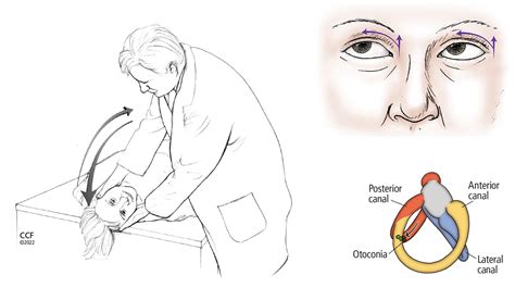 Figure From Benign Paroxysmal Positional Vertigo BPPV 47 OFF