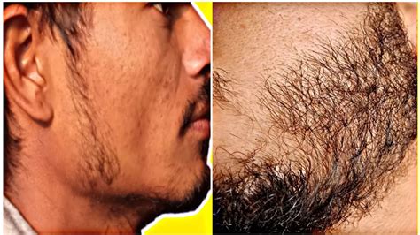 दाढ़ी उगाने का घरेलू उपाय Beard Growth Home Treatment Youtube