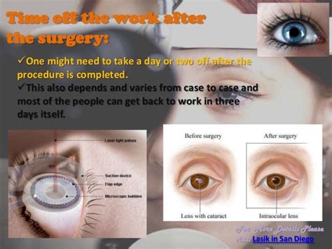 Lasik Eye Surgery San Diego