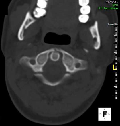 Jefferson fracture | Radiology Case | Radiopaedia.org