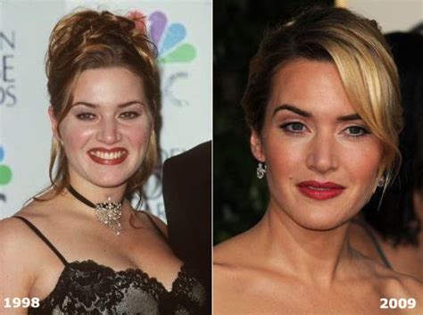 Kate Winslet Plastic Surgery Before and After Facelift and Breast ...