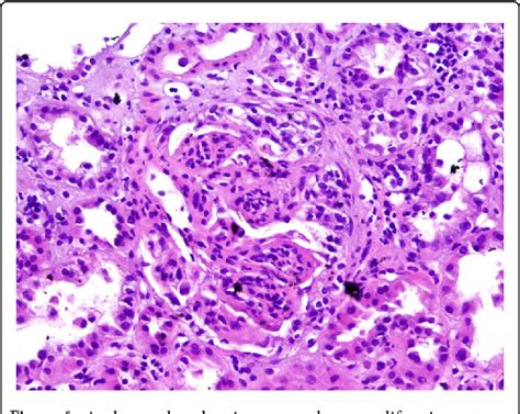 Figure 1 From Anti Glomerular Basement Membrane Disease Accompanied By Membranoproliferative