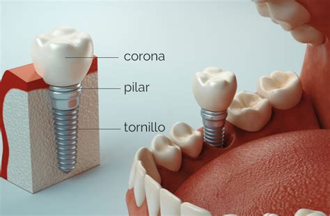 Partes De Un Implante Dental