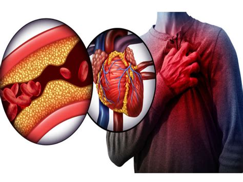 Esto Es Lo Que No Debes Hacer Si Tienes Colesterol Alto Salud180