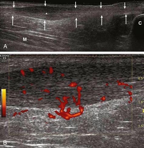 Achilles Tendon Injection Clinical Tree