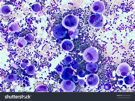 Malignant Cells In Pleural Fluid