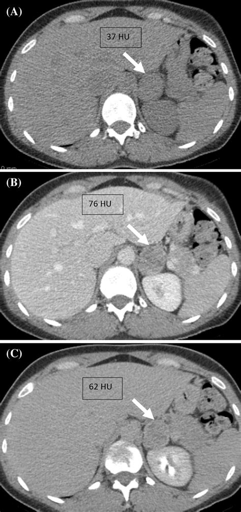 A 53 Year Old Female With Incidentally Discovered Left Adrenal Mass