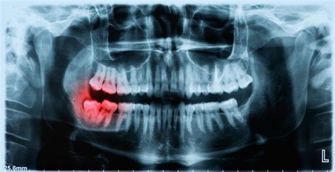 Normal Wisdom Teeth X Ray - TeethWalls