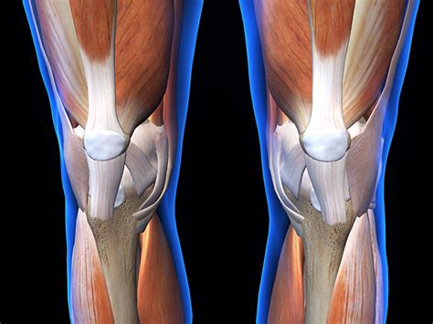 Physical Solutions | Patellar Tendonitis - Physical Solutions