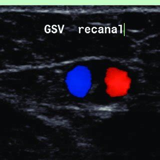 Duplex ultrasound of the great saphenous vein 10 cm under the ...