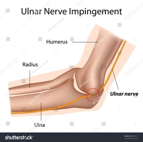 Ulnar Nerve Impingement Cubital Tunnel Syndrome Stock Vector