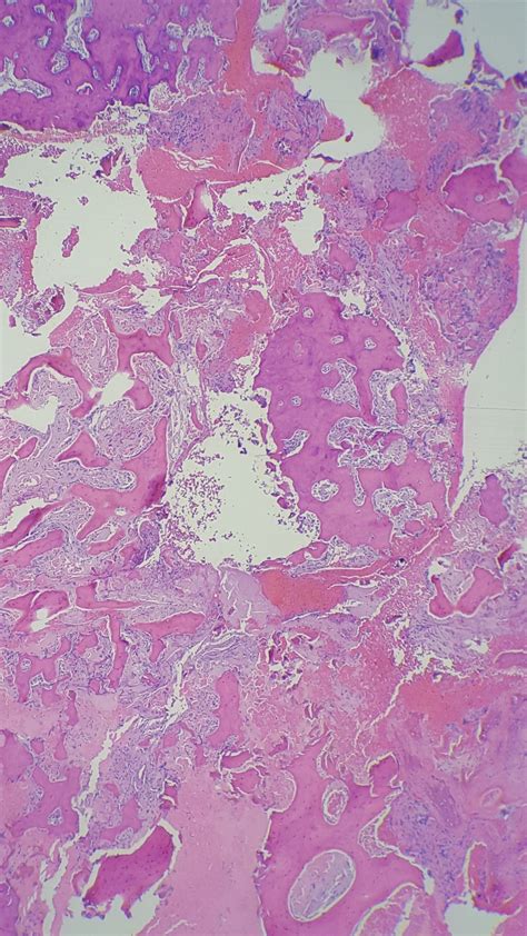 Osteoblastoma Histology