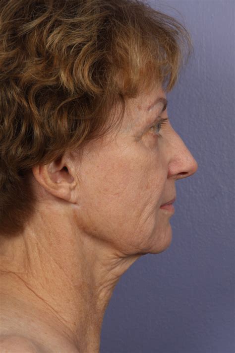 Los Angeles Facelift Before And After Photos Beverly Hills Plastic