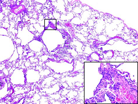 My Approach To Interstitial Lung Disease Using Clinical Radiological