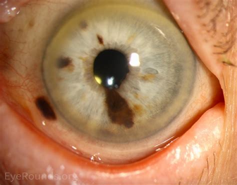 Atlas Entry Iris Melanoma