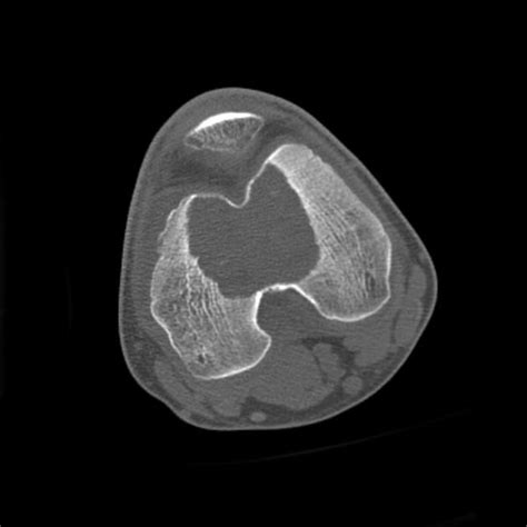 Chondroblastoma Distal Femur Radiology Case