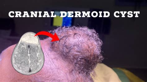 Cranial Dermoid Cyst Youtube