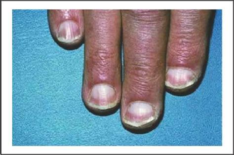 half and half nails - Ethicare Remedies