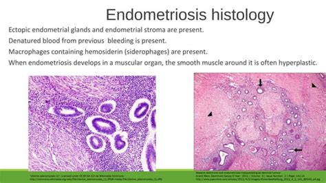 Pathology Of Polycystic Ovarian Disease And Endometriosis 2018 Sufia