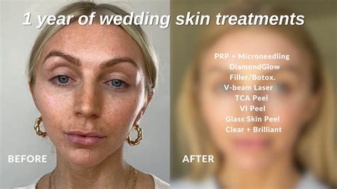 1 YEAR OF WEDDING SKIN CARE Microneedling PRP DiamondGlow V Beam