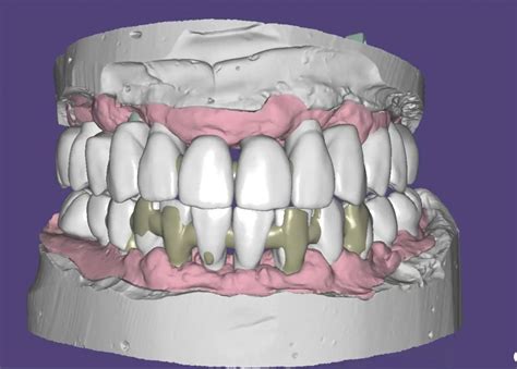 Prótesis CAD CAM Implantologia