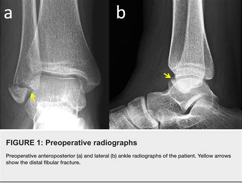 Figure 1 from Isolated Lateral Malleolar Fracture Treated with a ...